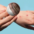 Khẩn trương truy vết nguồn lây của người đàn ông mắc đậu mùa khỉ ở Đồng Nai