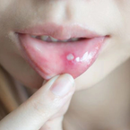 8 dấu hiệu của ung thư khoang miệng, những thói quen cần tránh để giảm nguy cơ ung thư