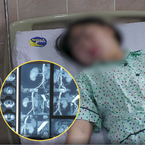 Mẹ hiến thận cứu con gái và cảnh báo của bác sĩ về thói quen gây hại cho thận