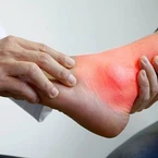 Bệnh 'người già' ngày càng trẻ hóa: Chàng trai 22 tuổi mắc gout, phòng tránh ra sao?