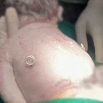 Em bé được cứu chữa từ trong bụng mẹ, chào đời với 'đôi cánh tí hon'