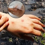 Bộ Y tế khuyến cáo 8 biện pháp phòng bệnh ‘sốt đất’ sau 23 ca tử vong ở Thái Lan