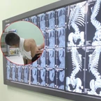 Dấu hiệu nhận biết sớm cong vẹo cột sống ở trẻ