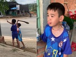 Bé trai nghịch tổ ong bị đốt sưng miệng