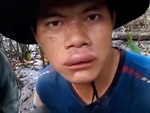 Chàng trai đi bắt cua bị ong đốt sưng miệng
