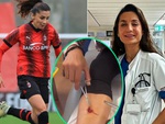 Nữ cầu thủ AC Milan gây sốt khi tự khâu vết thương chính mình