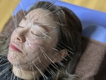 'Hóa nhím' vì phương pháp châm cứu thời thượng