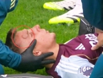 Hậu vệ Aston Villa u đầu vì va chạm với đồng đội Emiliano Martinez