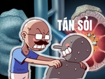 Đắk Lắk: Tán sỏi cho 480 bệnh nhân dù máy đã hỏng 2 năm