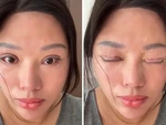 Người phụ nữ không thể nhắm kín mắt suốt 6 năm