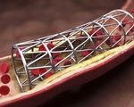 Không phải cứ hẹp mạch máu là đặt stent