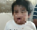 Bé gái 4 tuổi nhập viện với nhiều vết thương, bệnh viện liền báo công an