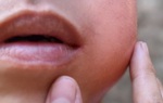 Tự ý điều trị mụn nhọt có thể nguy hiểm tính mạng