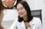 Tự ý dùng tretinoin để 'đổi da cấp tốc' đón Tết, nhiều chị em phải nhập viện điều trị