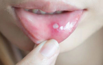 8 dấu hiệu của ung thư khoang miệng, những thói quen cần tránh để giảm nguy cơ ung thư