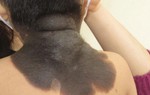 Bớt đen bẩm sinh ở trẻ, cẩn trọng nguy cơ ung thư da