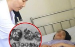 Phẫu thuật và bảo tồn tử cung cho nữ bệnh nhân có 19 khối u xơ hiếm gặp