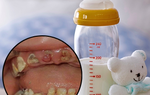 Chú ý: Thói quen bú bình ảnh hưởng đến phát triển răng miệng ở trẻ em
