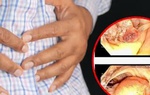 5 người trong gia đình cùng mắc ung thư đại tràng, bác sĩ khuyến cáo điều gì?