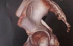 Bé gái mắc hội chứng người hóa đá cực hiếm: Bác sĩ Bệnh viện Nhi đồng Thành phố khuyến cáo gì?