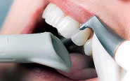 Vệ sinh răng sứ đúng cách để sau phục hình răng đảm bảo bền đẹp lâu dài