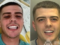 Tên tội phạm bị bắt vì khoe răng 'sáng như quảng cáo'