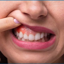 Podcast: Những dấu hiệu cảnh báo ung thư miệng rất dễ bị bỏ qua