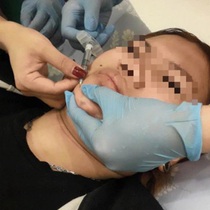 Thêm một bệnh nhân tử vong sau khi phẫu thuật căng da mặt