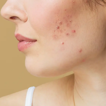Phát hiện hóa chất gây ung thư trong một số mỹ phẩm trị mụn