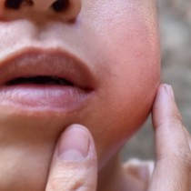Tự ý điều trị mụn nhọt có thể nguy hiểm tính mạng
