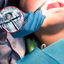 Hoại tử xương hàm, chớ có xem thường, hãy nghe cảnh báo từ bác sĩ