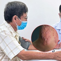 Bác sĩ cảnh báo biến chứng nguy hiểm của bệnh zona thần kinh