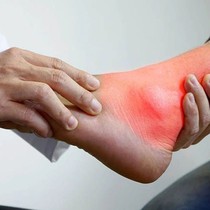 Bệnh 'người già' ngày càng trẻ hóa: Chàng trai 22 tuổi mắc gout, phòng tránh ra sao?