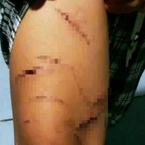Người nhà lên tiếng vụ bé gái lớp 5 nghi bị chị họ rạch nhiều vết thương