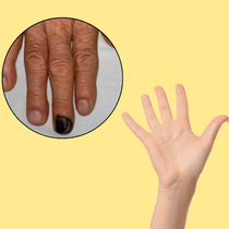 Móng tay màu đen như tụ máu là dấu hiệu của bệnh gì, có nguy hiểm?