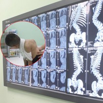 Dấu hiệu nhận biết sớm cong vẹo cột sống ở trẻ