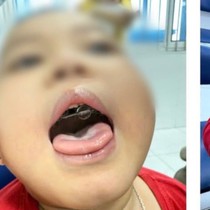 Bé trai 4 tuổi nhiều lần tím tái vì ngưng thở khi ngủ kéo dài