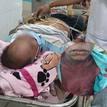 Nhỏ thuốc mắt, người đàn ông 51 tuổi bị hoại tử thượng bì nhiễm độc hiếm gặp