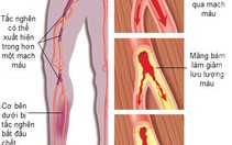 Tắc động mạch ngoại biên: âm thầm nhưng nguy hiểm