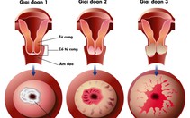 Sàng lọc phát hiện sớm ung thư cổ tử cung