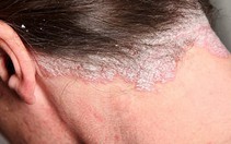 Chế độ ăn cho bệnh nhân đang mắc bệnh vảy nến