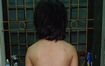 Bé trai sút 20kg nghi do cha ruột bạo hành