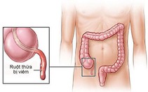 Những điều cần biết về viêm ruột thừa