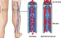 Những điều cần biết về bệnh huyết khối tĩnh mạch sâu