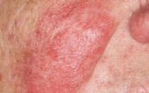 Phân biệt dị ứng thuốc thật - dị ứng thuốc giả
