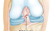 Chấn thương dây chằng chéo trước