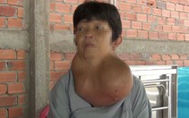 Cắt thành công bướu cổ nặng gần 5kg cho một phụ nữ