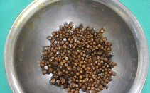 Nữ bệnh nhân có... gần 400 viên sỏi trong túi mật