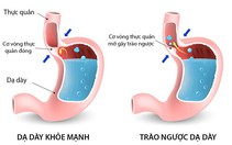 Cẩn thận với bệnh trào ngược dạ dày, thực quản