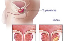 5 lầm tưởng thường gặp về ung thư tuyến tiền liệt